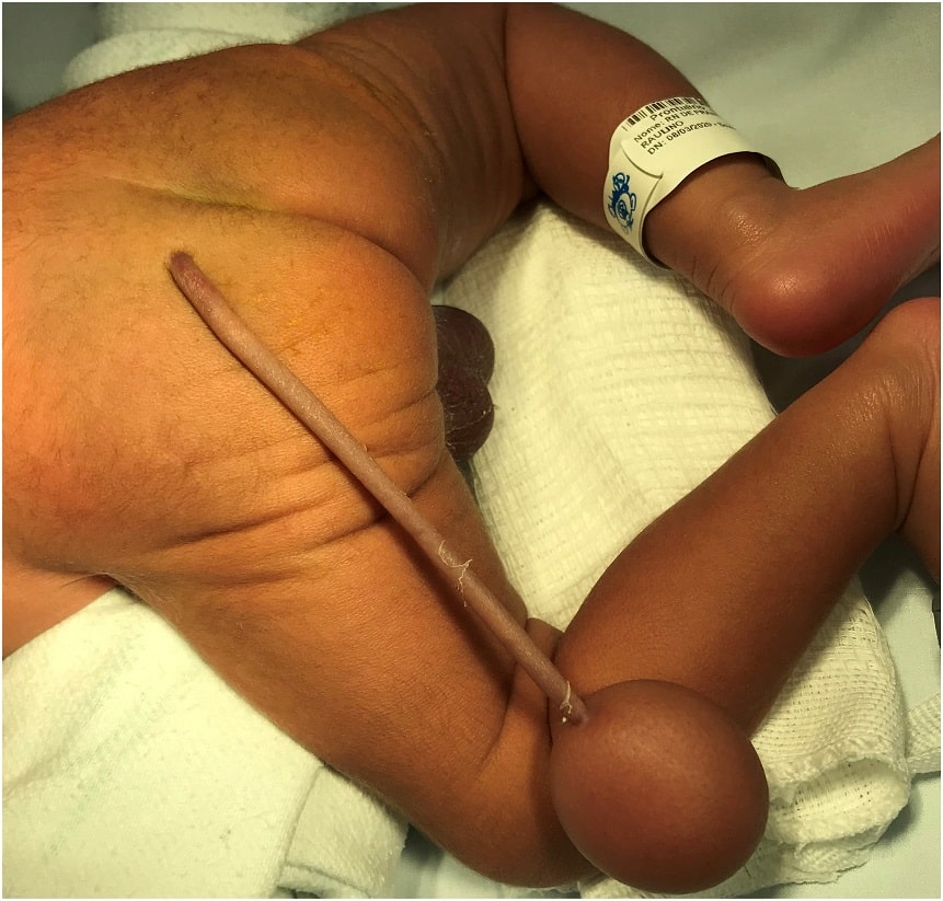 Baby Born With 12-cm Long 'Human Tail' in Brazil 