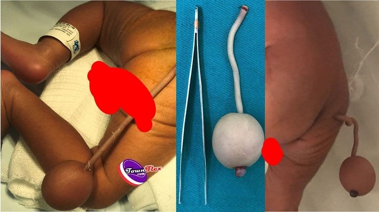 Baby Born With 12-cm Long 'Human Tail' in Brazil