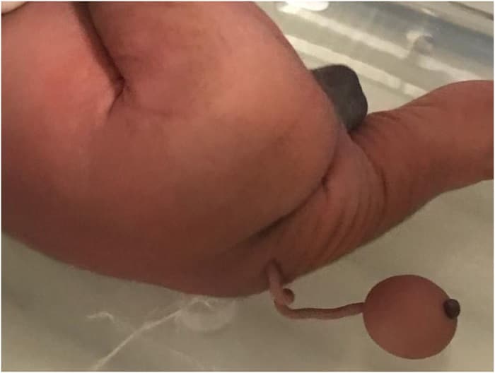 Baby Born With 12-cm Long 'Human Tail' in Brazil [See Photos]