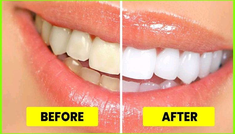 Natural Tips To Get Whitening Teeth