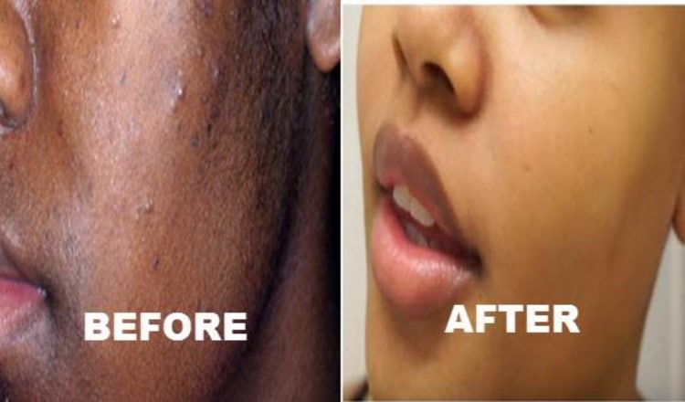 How to treat black spot and Pimples naturally