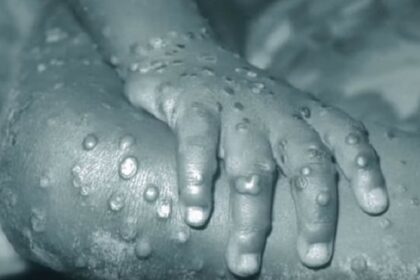 Nigeria Monkeypox - NCDC Releases Update On Situation
