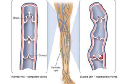 Common Vascular Conditions Treated by Vascular Surgeons in Vadodara