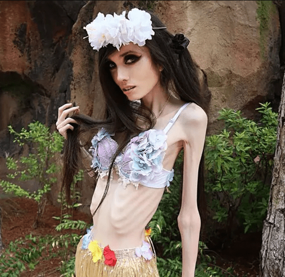 Eugenia Cooney's Thin Body Sparks Global Worries and Police Calls