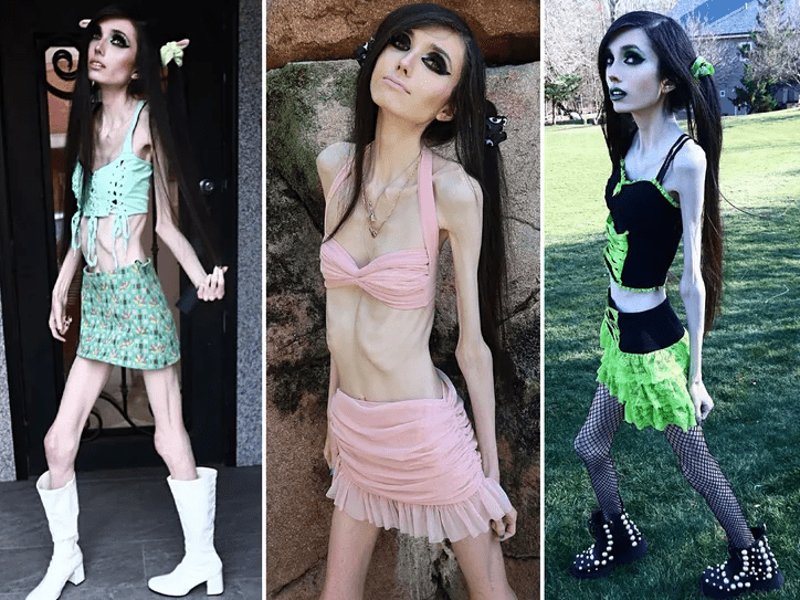 Eugenia Cooney's Thin Body Sparks Global Worries and Police Calls