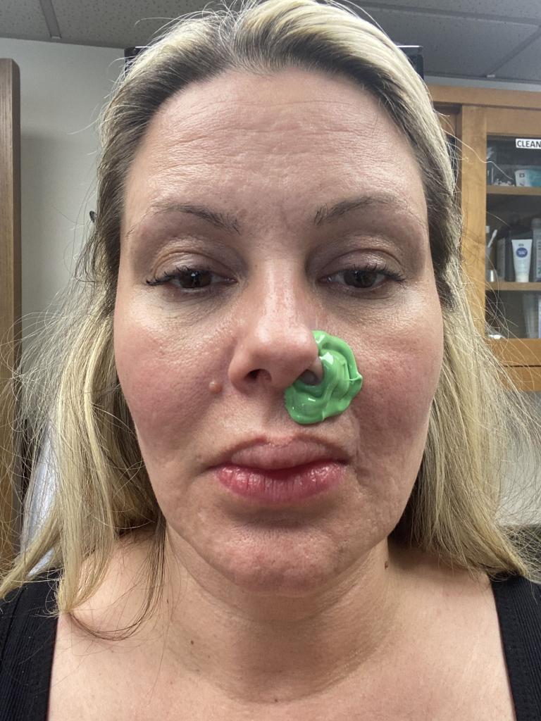 Woman's Nostril Falls Off After Having Anti-Aging Fillers