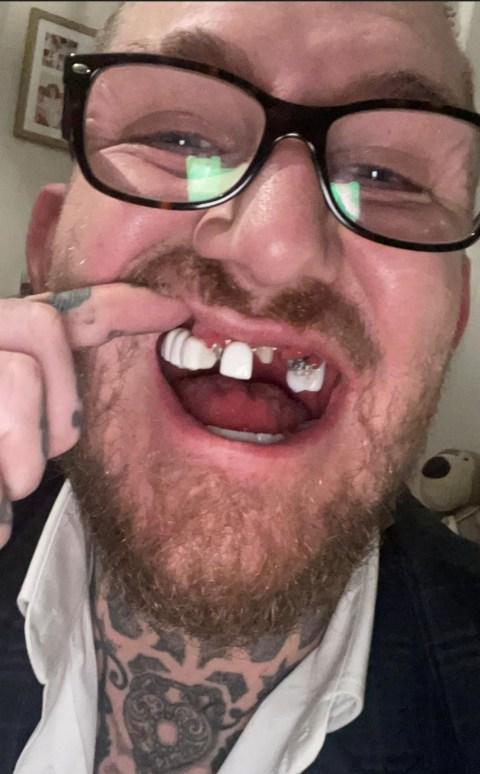 Man Spends 80k To Fix His Teeth After Coc@ine Abuse & This Shocking Detail (+PHOTOS) 2 Man Spends 80k To Fix His Teeth After Cocaine Abuse And This Shocking Detail