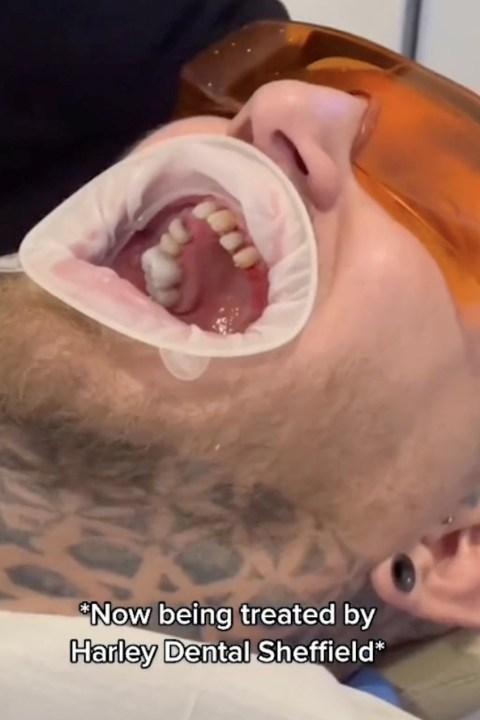 Man Spends 80k To Fix His Teeth After Coc@ine Abuse & This Shocking Detail (+PHOTOS) 4 Man Spends 80k To Fix His Teeth After Cocaine Abuse And This Shocking Detail