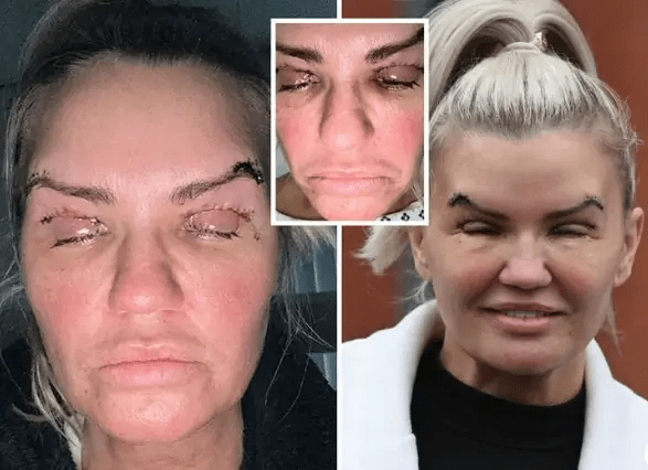 Kerry Katona's Struggle: Battling Swelling and Stitches After Eye-Lift Surger