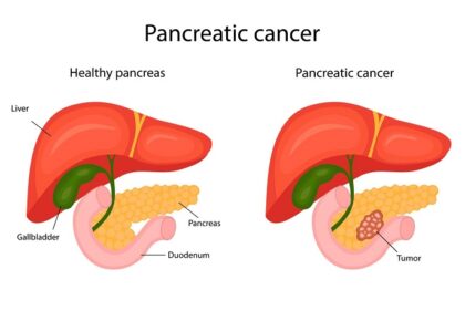 Pancreatic Cancer: Symptoms, Causes, and Treatment