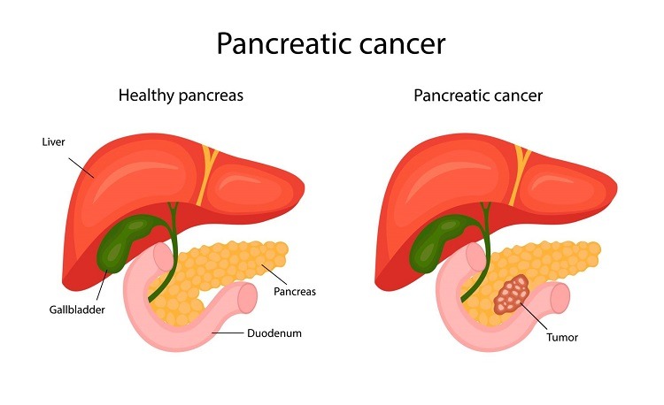 Pancreatic Cancer: Symptoms, Causes, and Treatment
