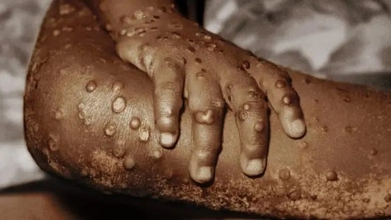 Ghana Reports First Mpox Case in 2024 As Virus Spreads In Africa