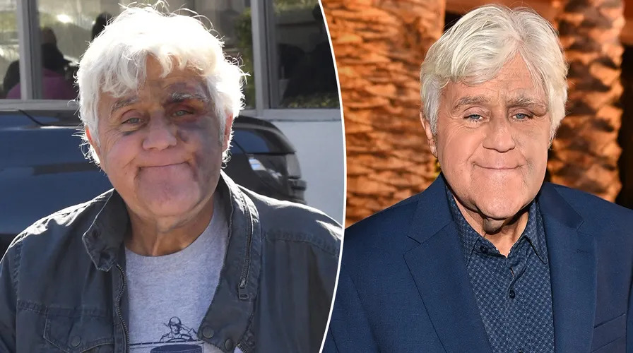 Jay Leno Looks Better Than Ever After Nasty Fall Left Him Bruised