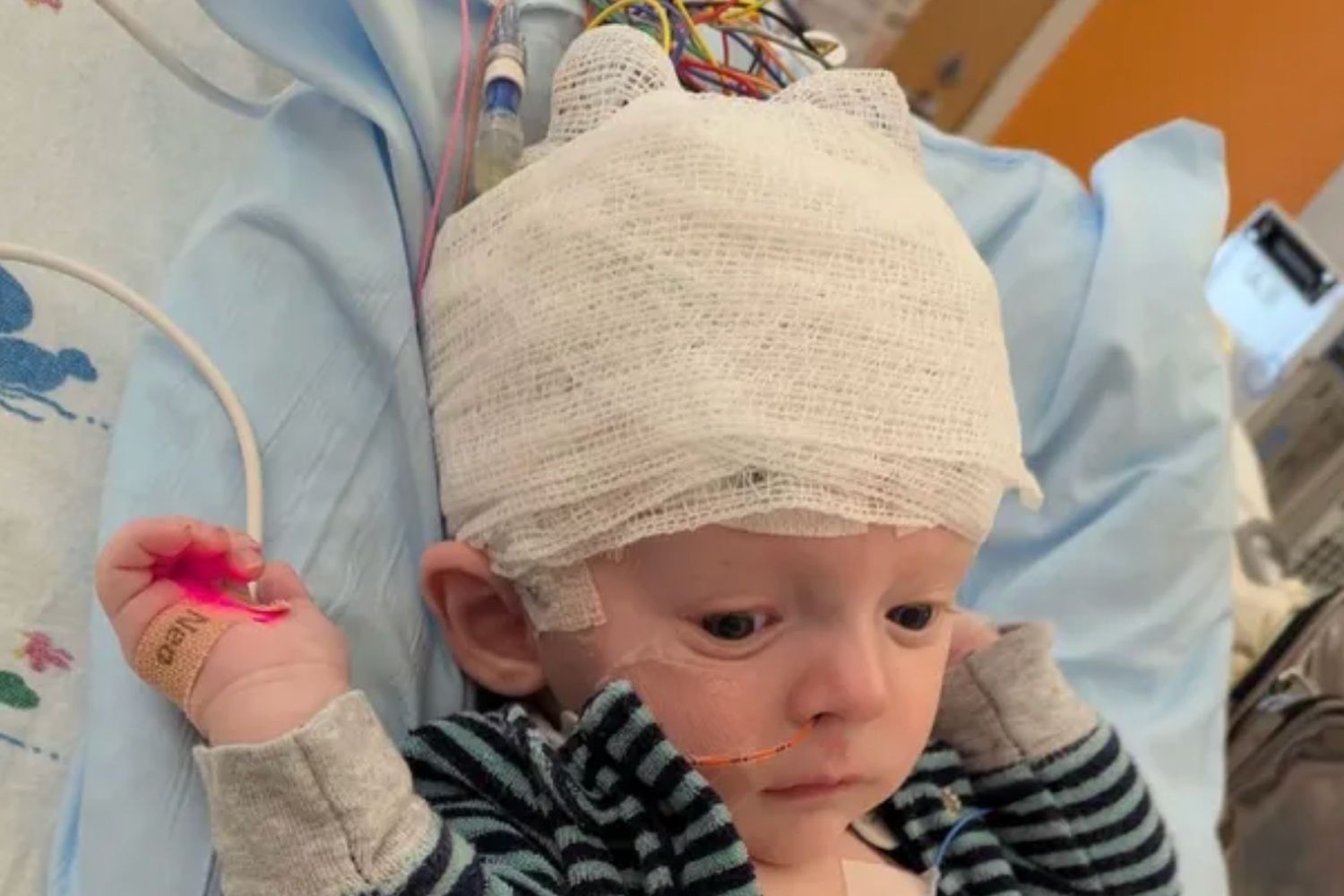 Baby Caper Undergoes $5 Million Surgery Surgery to Remove Half of His Brain