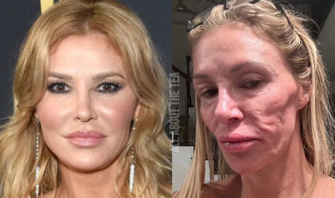 Brandi Glanville’s Shocking Selfie: TV Star Opens Up About Parasite Health Scare