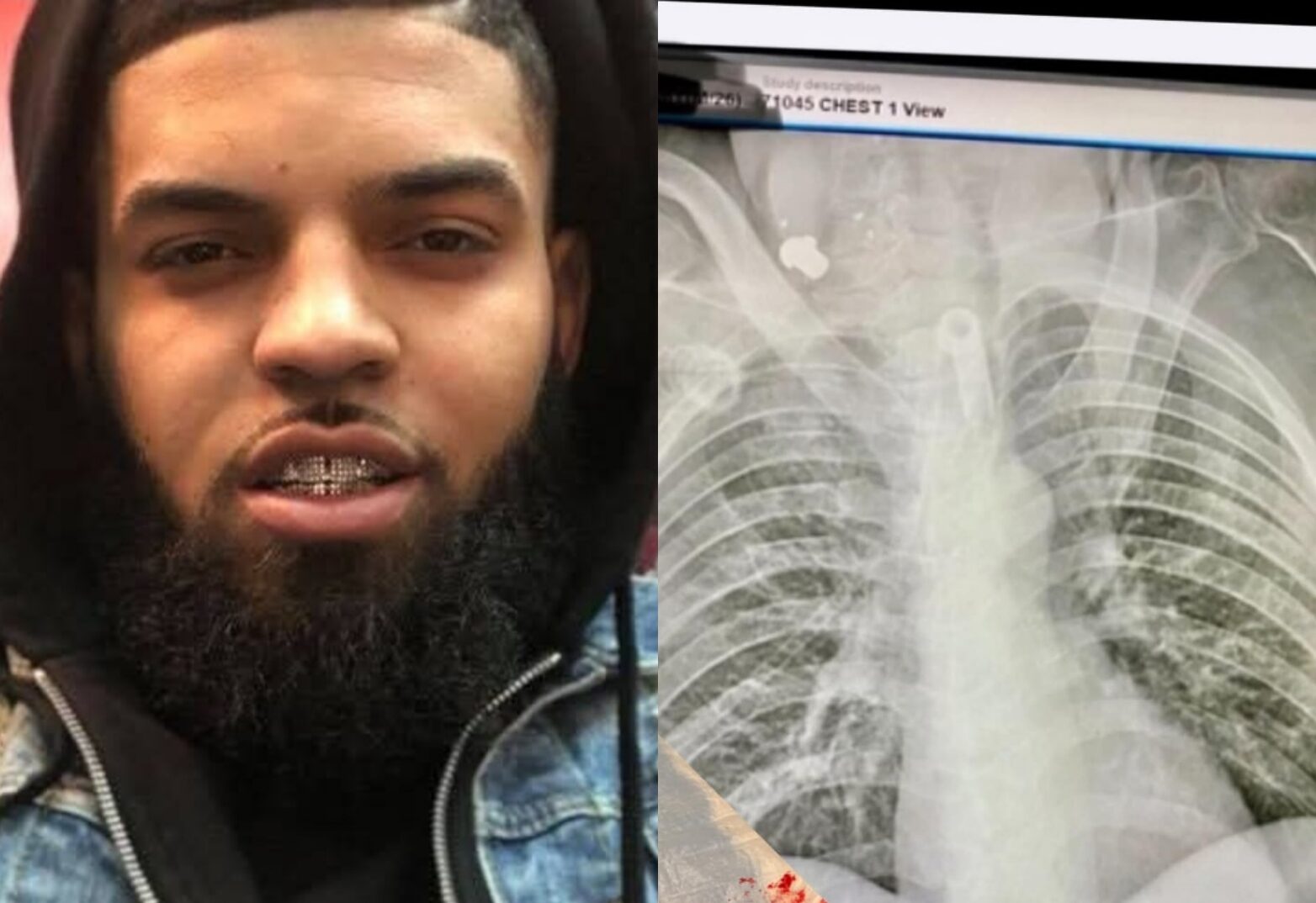 MIRACLE! Bullet Leaves Man’s Body on Its Own After 5 Years, Thanks to Faith