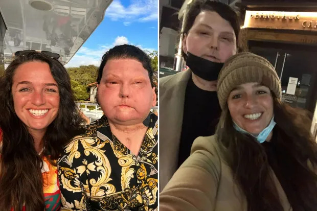 22-Year-Old Burn Survivor Finds Love with Nurse After Historic Face Transplant